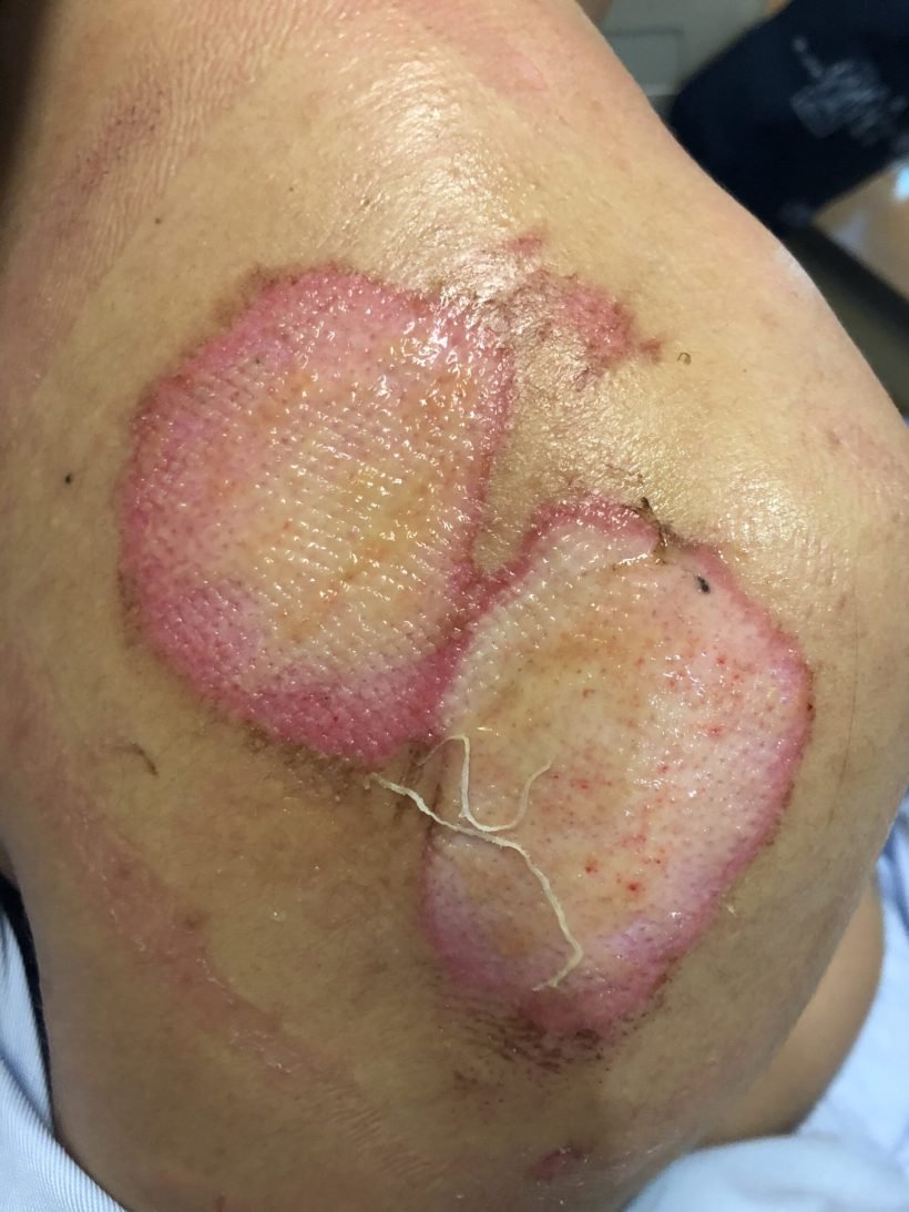 motorbike injuries on shoulders